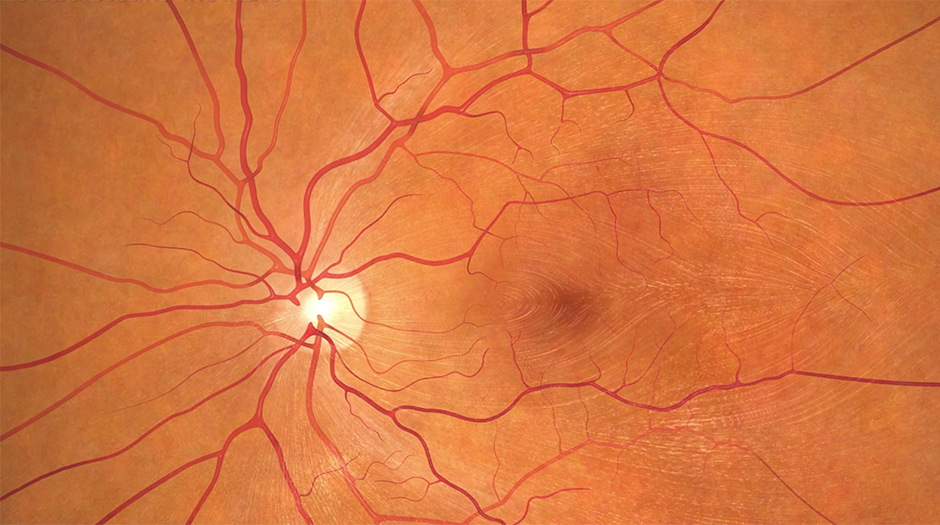 Featured image for “Are you at risk for Diabetic Retinopathy?”