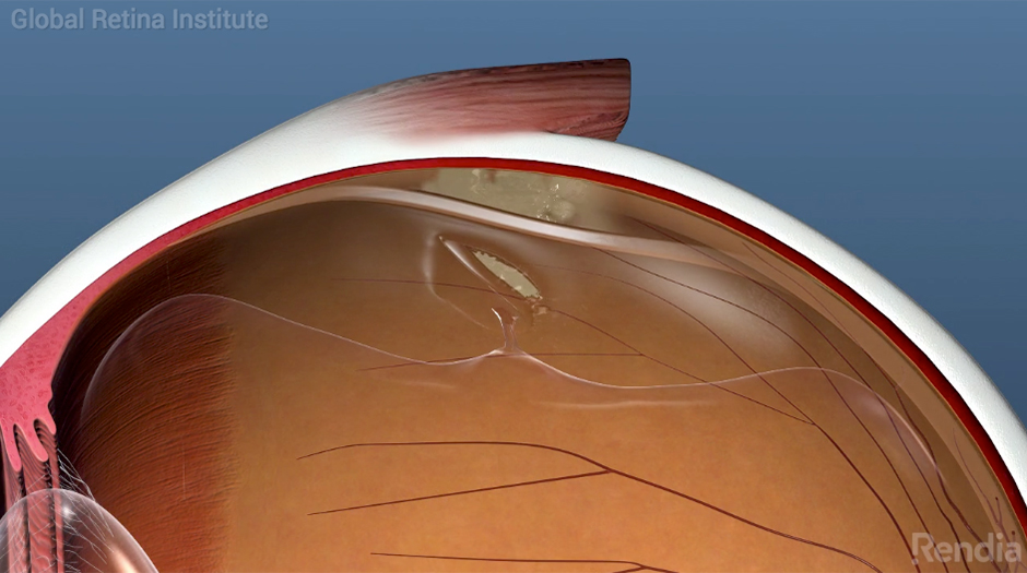 Featured image for “Understanding Laser Floater Treatment (LFT)”