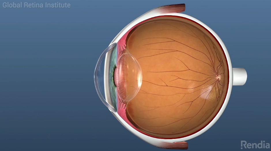 Featured image for “What are Posterior Vitreous Detachments (Floaters)?”