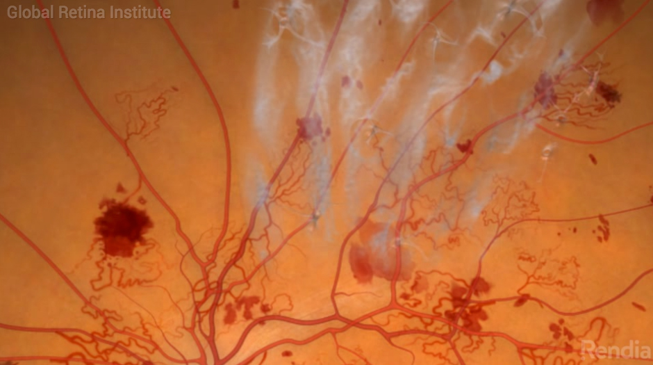 Featured image for “What is Proliferative Diabetic Retinopathy?”